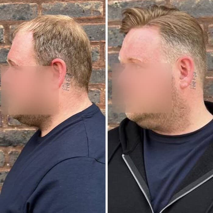 Client before and after: thinning crown to full styled hair