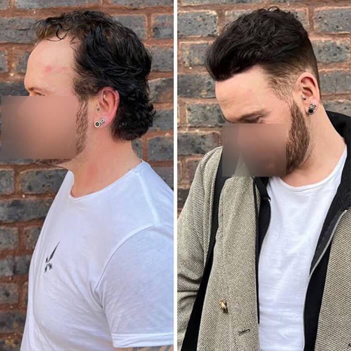 Client before and after: front thinning to full hair