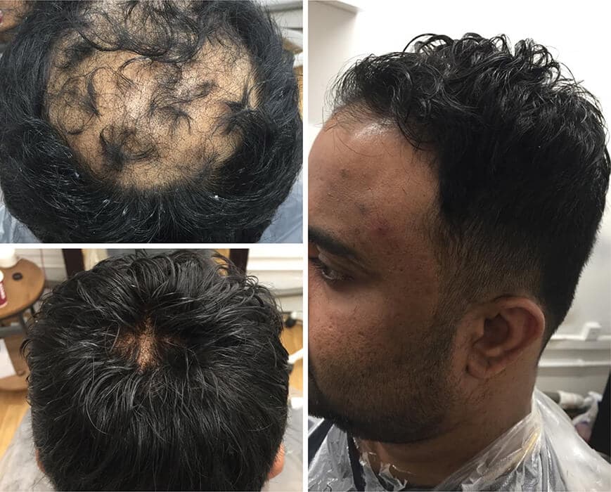 ManHair studio: men's hair replacement consultation