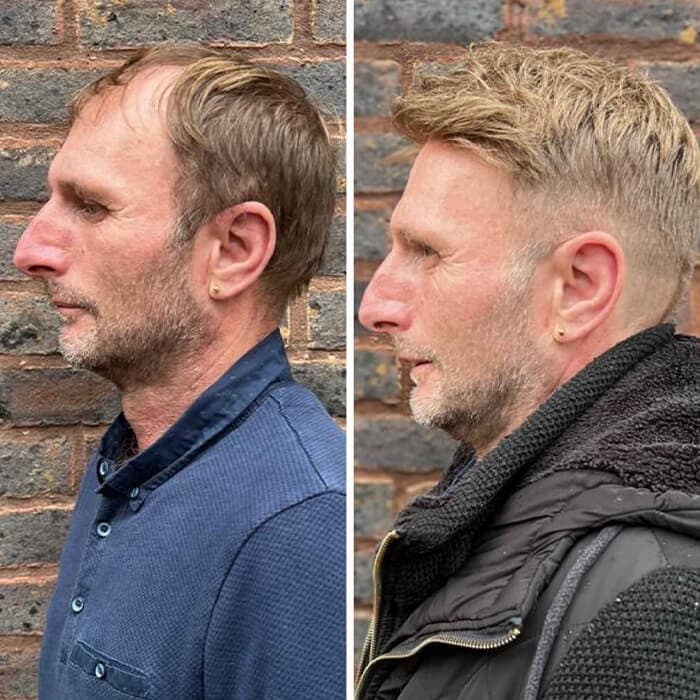 Are Hair Replacement Systems worth it?