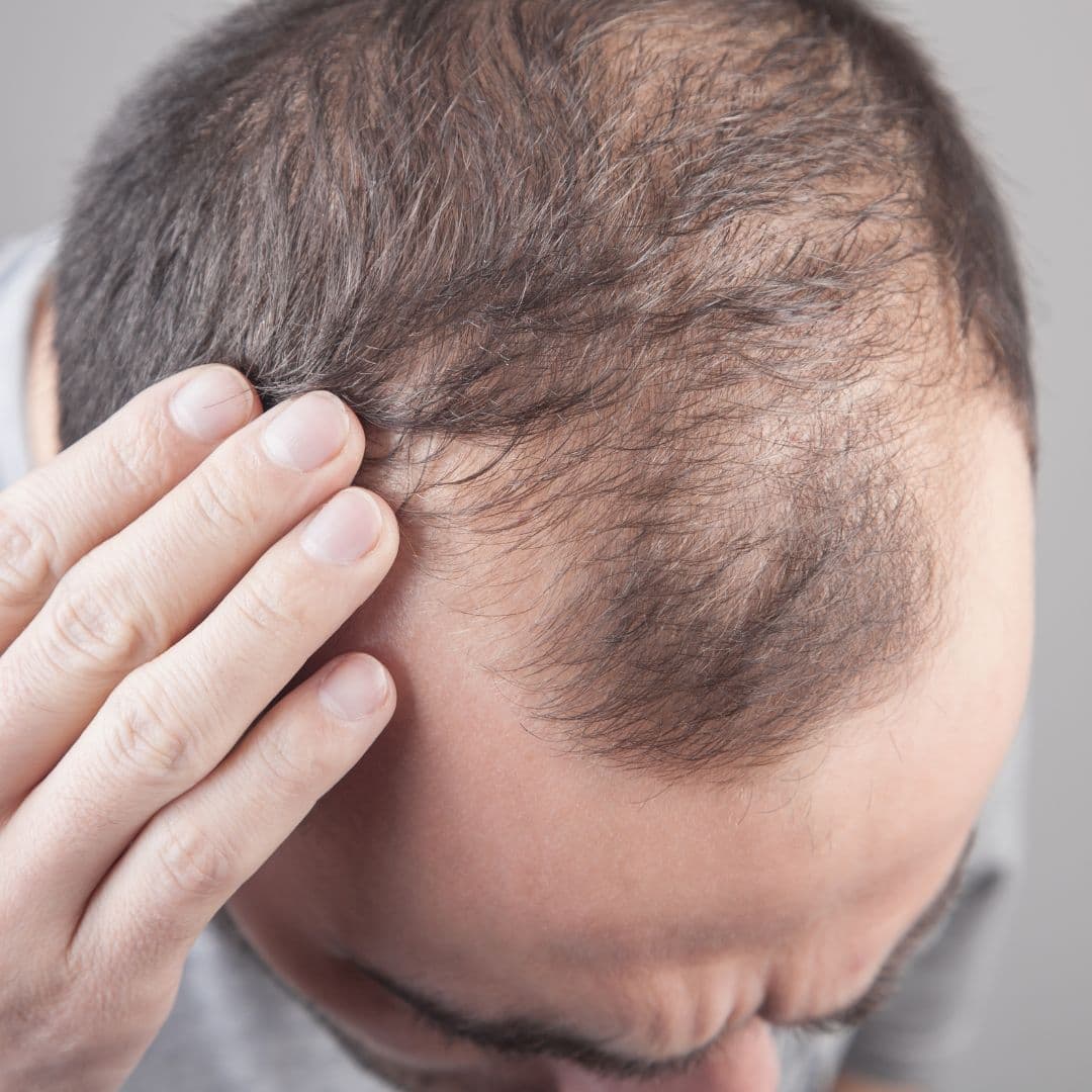 5 Tactics That Help Slow Aging Hair Loss In Men